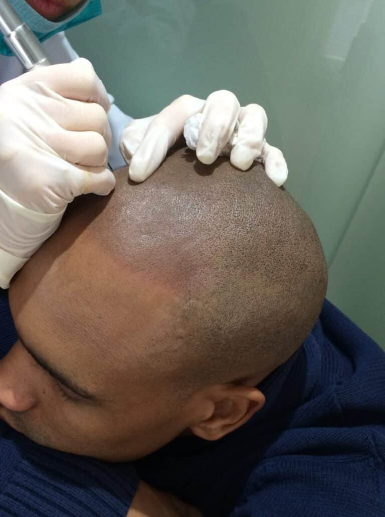 Micropigmentation des cheveux